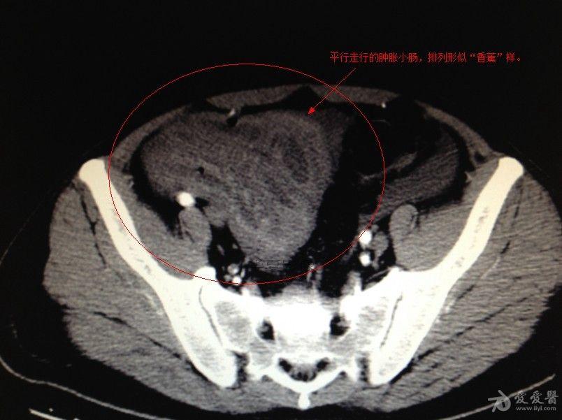 急腹症ct表现----肠扭转 - 医学影像学讨论版 - 爱爱