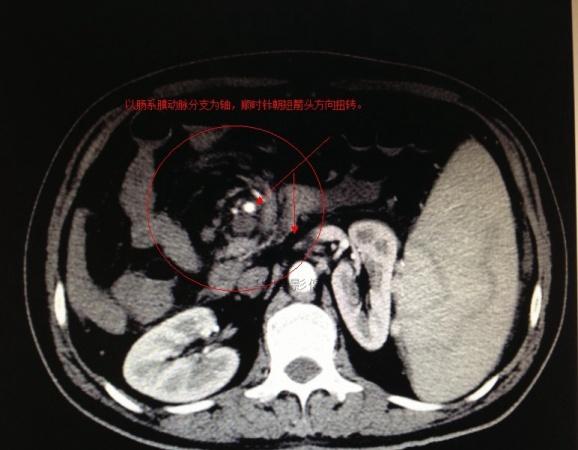 急腹症ct表现----肠扭转