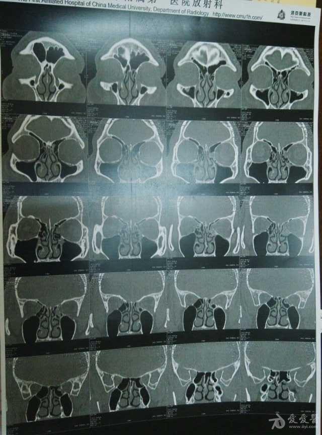 左侧眼眶内壁骨折伴左侧筛窦内积血积液,求指点