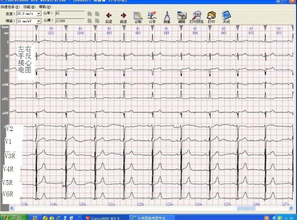 心电图讨论---反接后的下壁导联是否异常