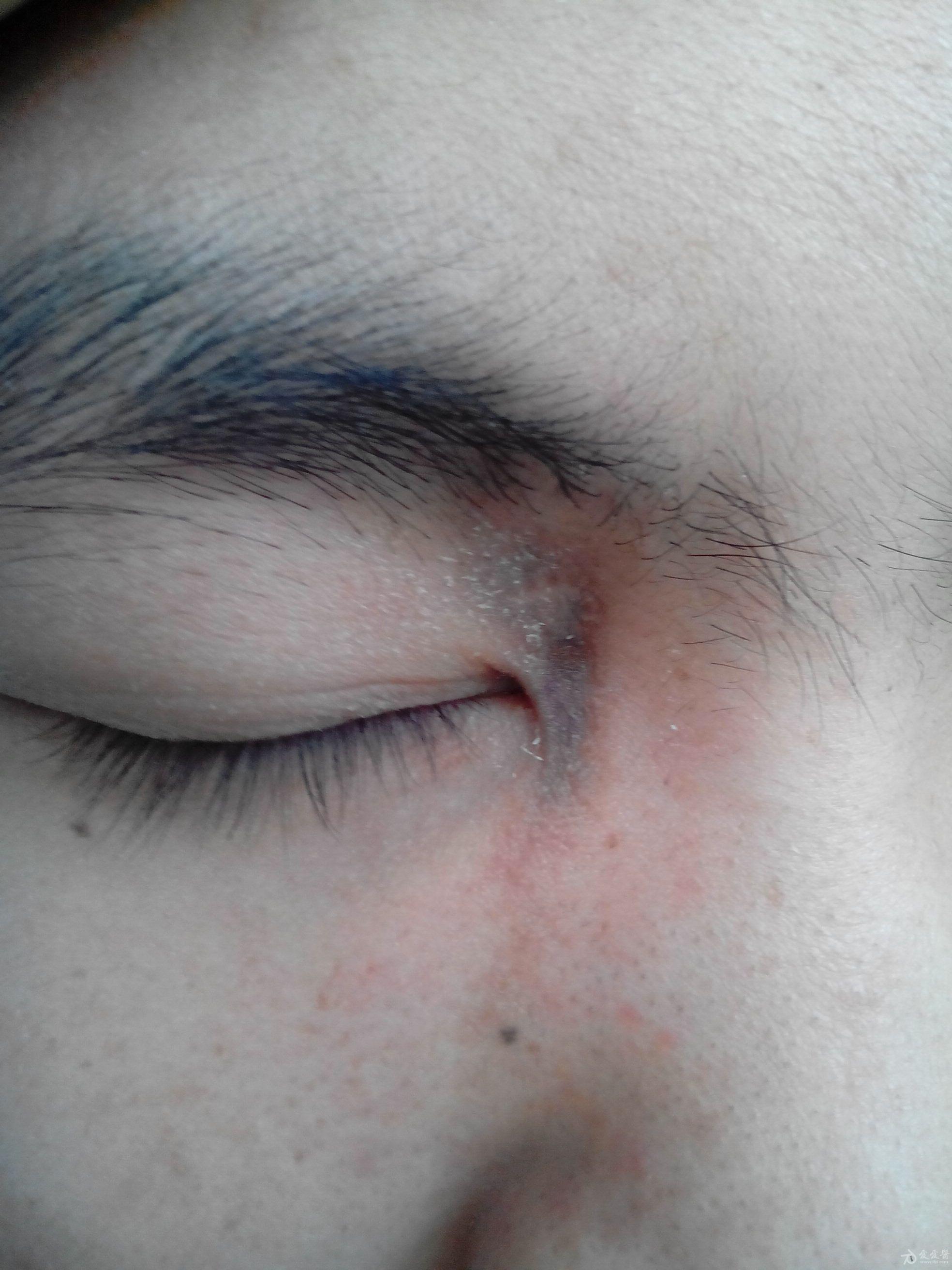 右眼睑条索状紫红斑 无痛痒三月 c3 c4 化验补体阳性