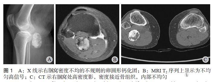 【分享】腘窝瘤样钙化症1例