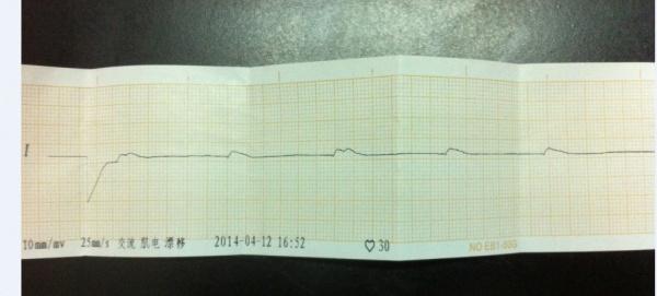 这个该怎么打,临终前经常遇到这样图 - 心电图脑电图