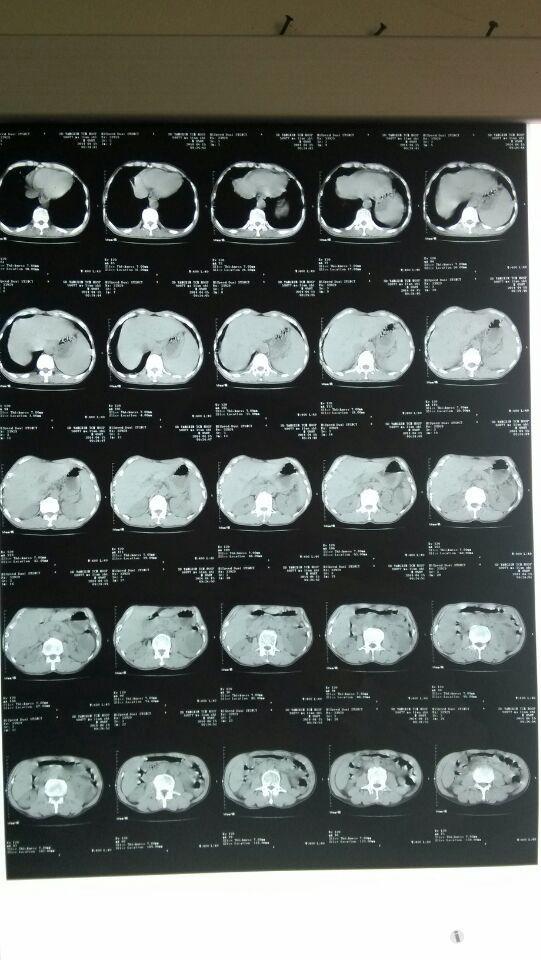 4楼回复白衣安琪        复查ct汇报.