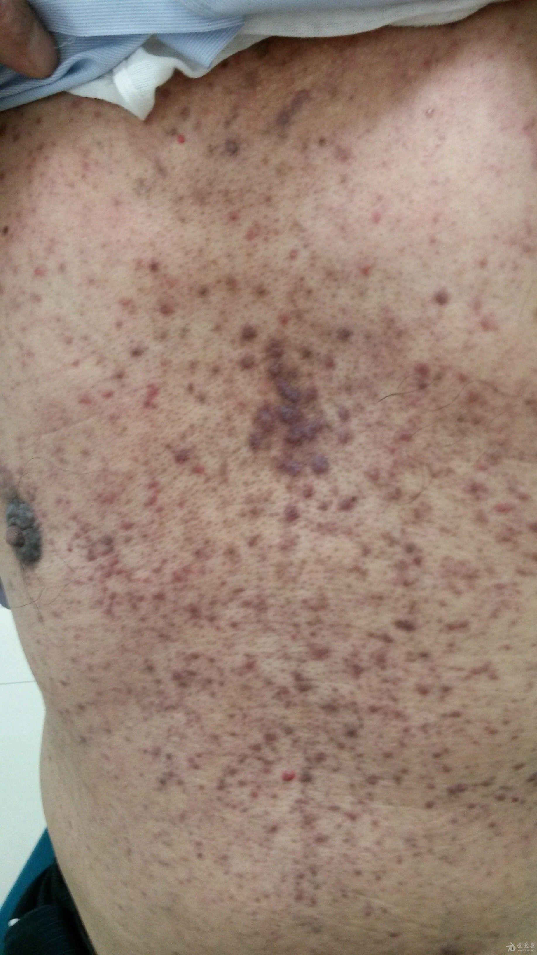 患者男性,62岁,全身斑疹丘疹微痒1年余.