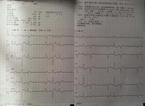 步行百米后即出现憋气,胸部ct显示双侧胸腔积液,双肺肺炎,门诊心电图