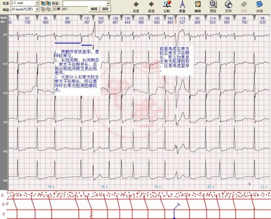 3,【鉴别诊断】4,【临床意义】患者女性,74岁,以心悸