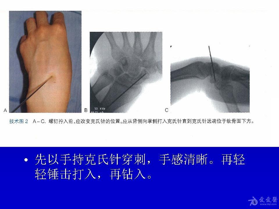 经皮螺钉固定腕舟骨骨折 - 骨科与显微外科专业讨论版