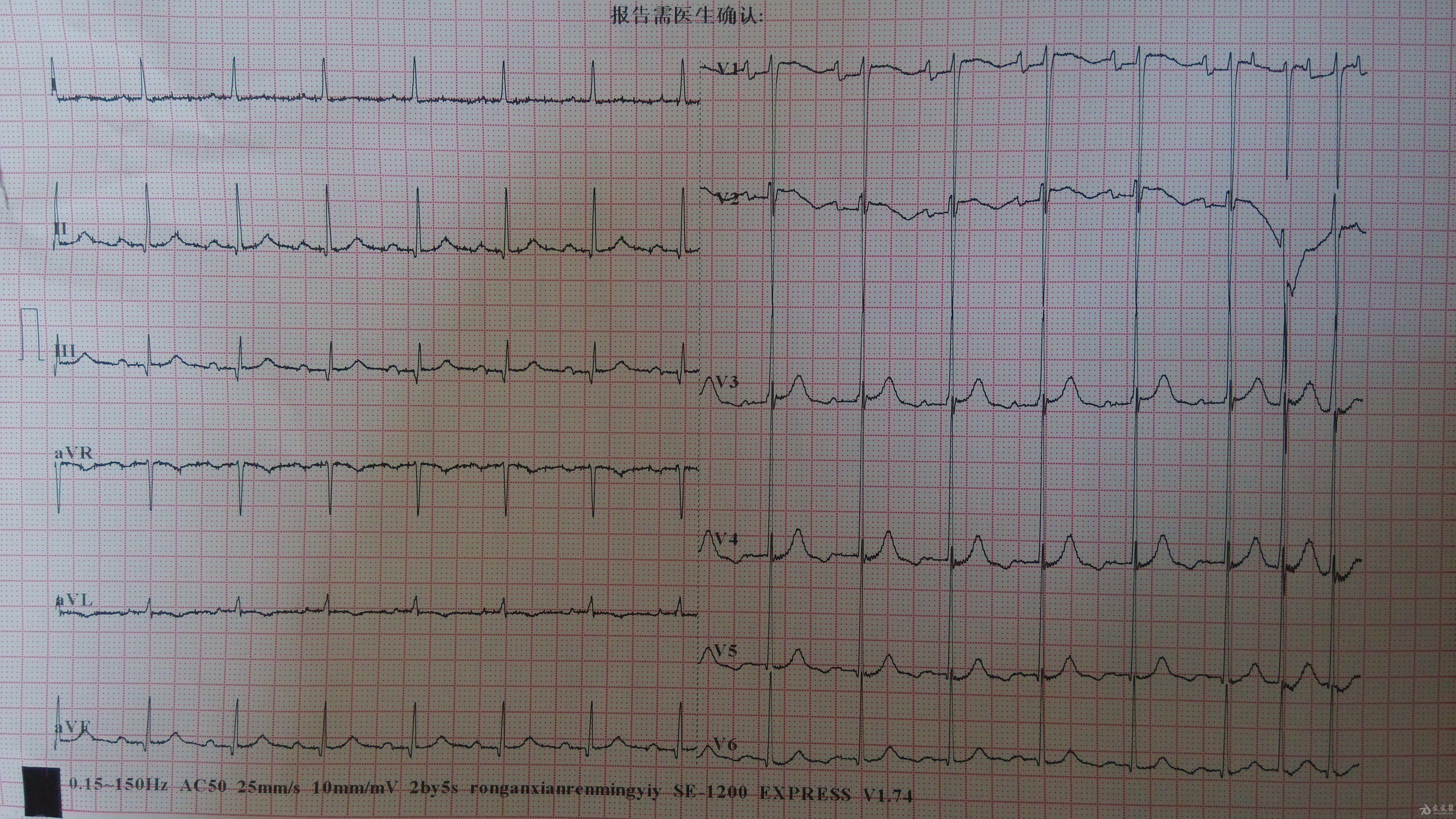 这得是什么病呢,把自己的心搞这么乱 - 心电图脑电图