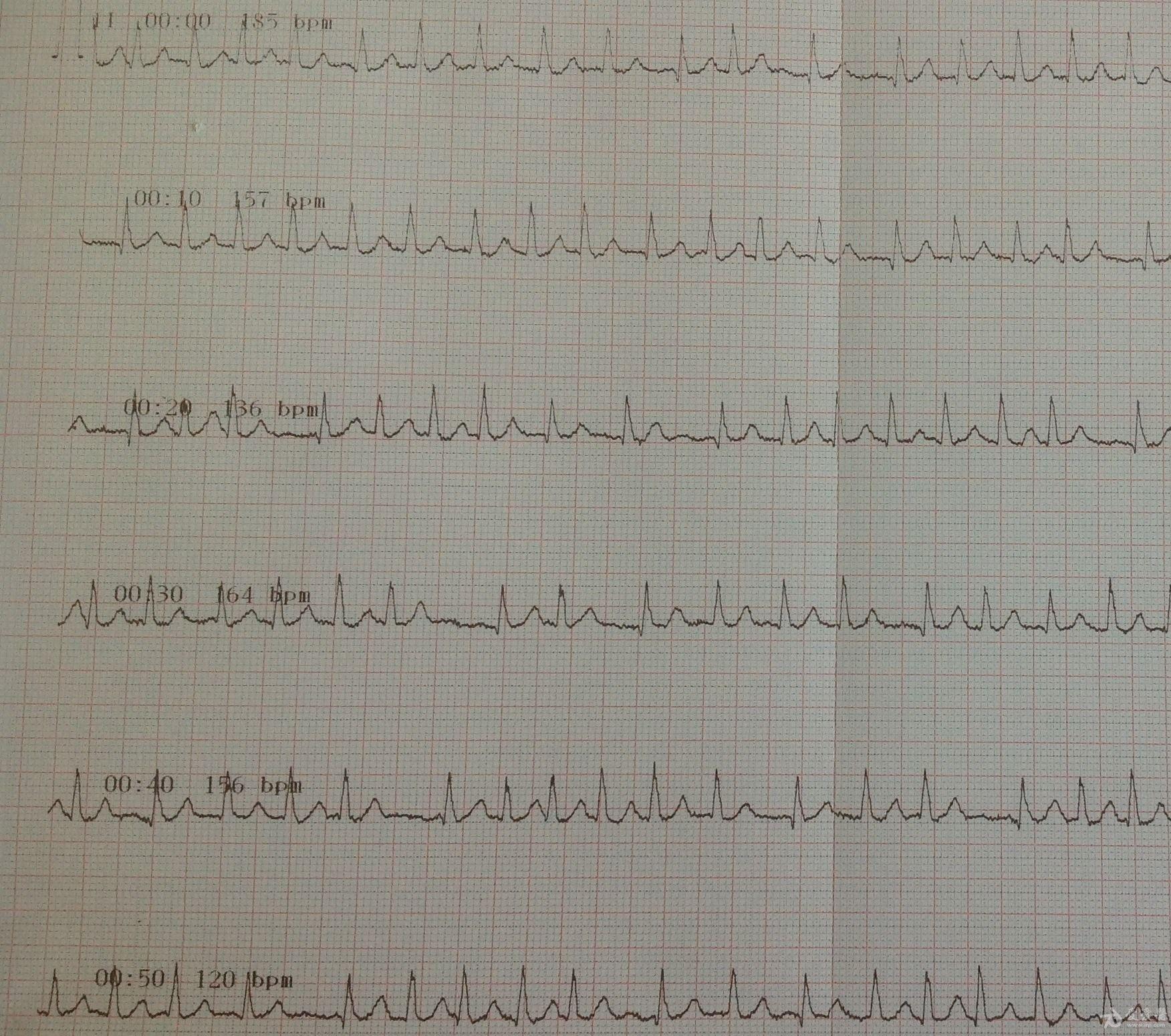 房速的 - 心电图脑电图专业讨论版 - 爱爱医医学论坛