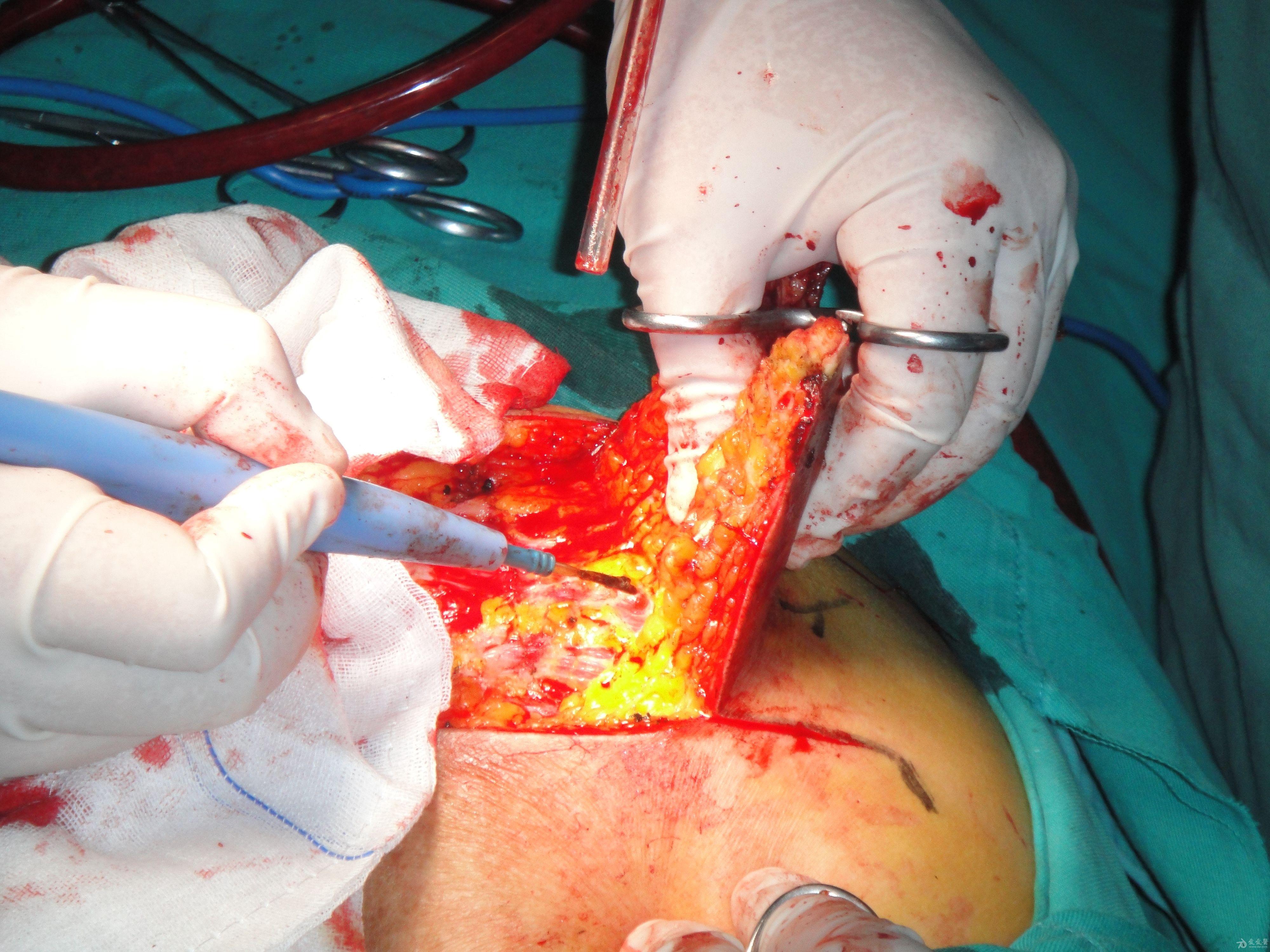 骶尾部溃疡手术加转移性皮瓣