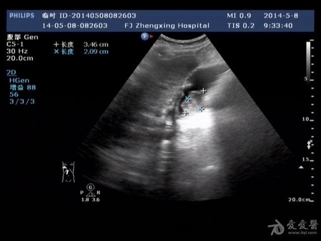 胆囊癌,胆总管内也是栓子 - 超声医学讨论版 - 爱爱医