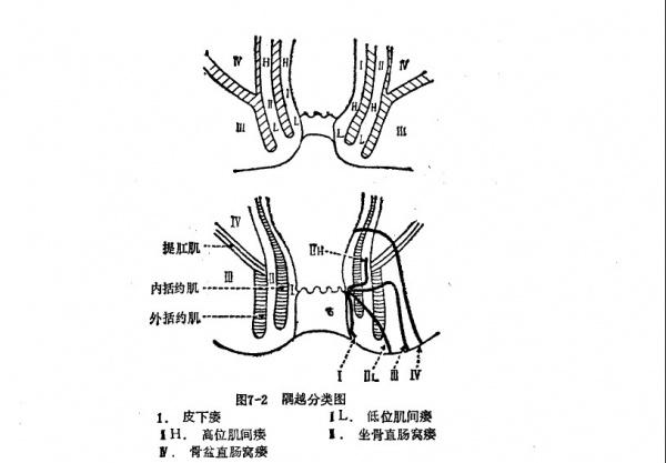 肛瘘临床分型请各位帮我补充完整谢谢