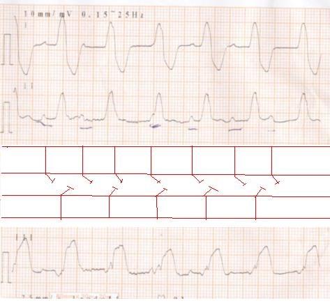 请教下壁心梗室颤后心电图一份