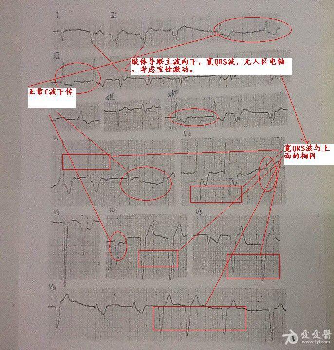 女64岁 先天性心脏病 房间隔缺损 心衰3级 - 心电图脑