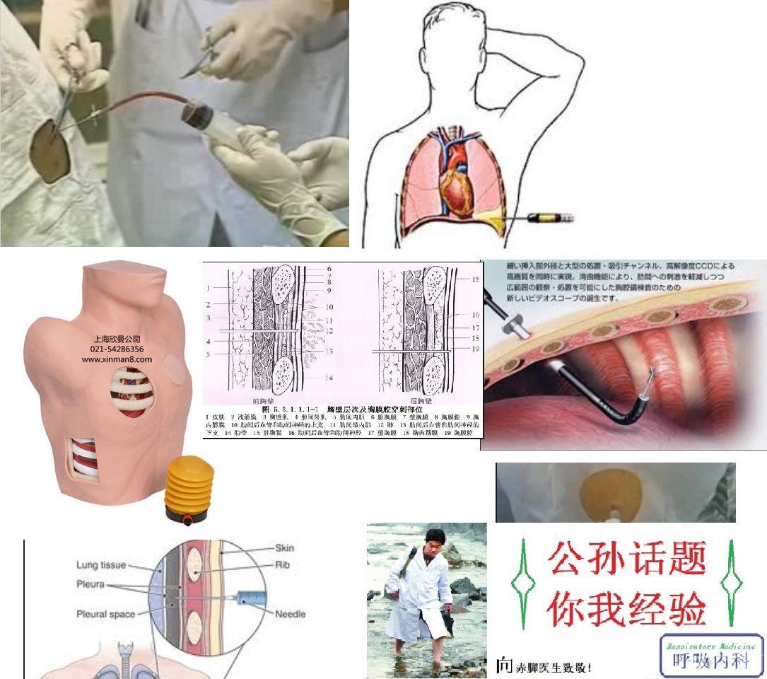 【公孙话题】说说你胸腔穿刺遇到的问题.