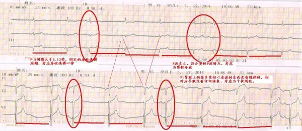 12秒,固定的房性逸搏周期,考虑房性逸搏心律,红圆圈中p波直立,符合窦