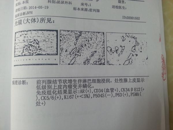 前列腺增生的免疫组化