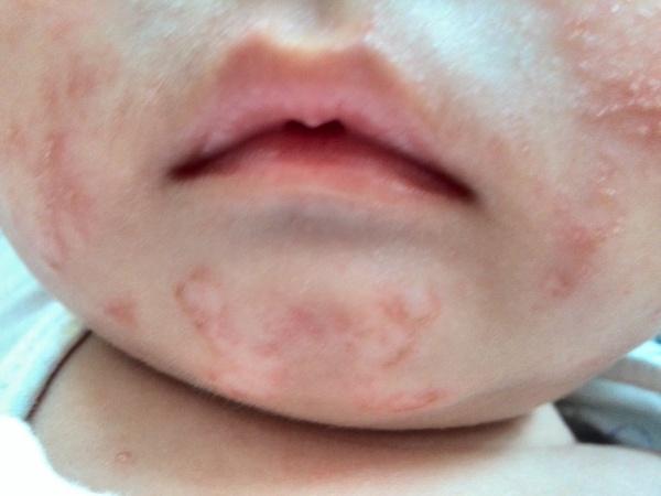 婴儿脸上长有红疹,天气一热,就又复发