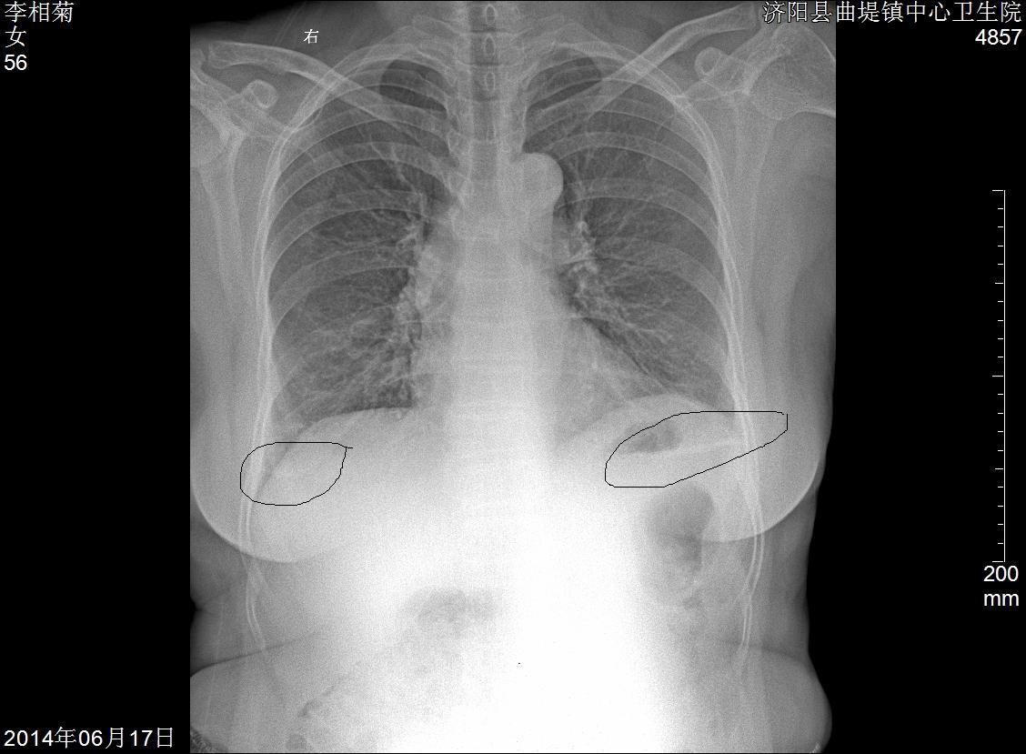 x线 x光 x光片 x线 1128_829