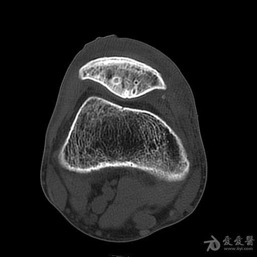 ct扫描示右膝关节骨质密度减低,是骨质疏松还是骨髓瘤?请专家解惑