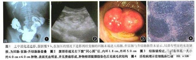 【学习】回盲部套细胞淋巴瘤致肠套叠