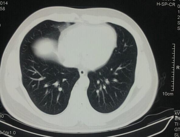 老师帮忙看看下少许间质性肺炎怎么样?新增66张ct