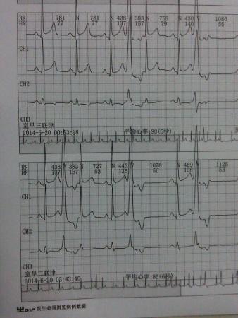 室早伴反复搏动 - 心电图脑电图专业讨论版 - 爱爱医