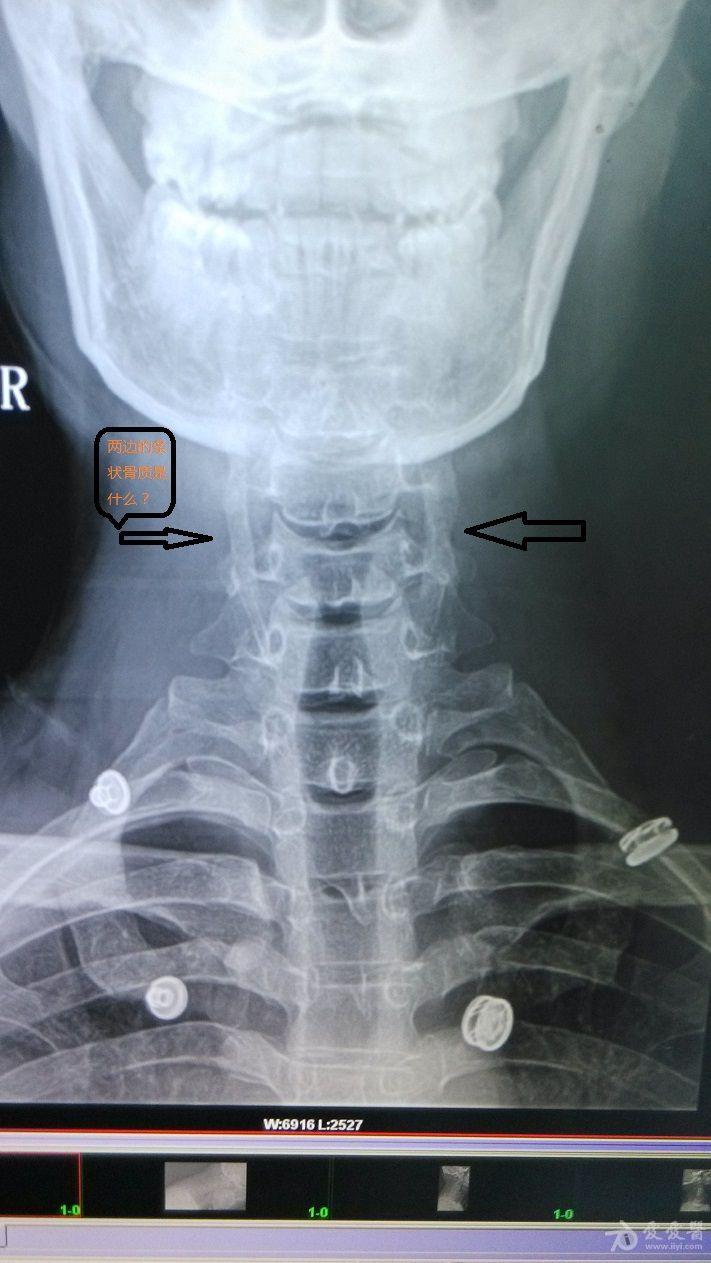 请老师们指导,颈椎正位两边的骨质影是什么?