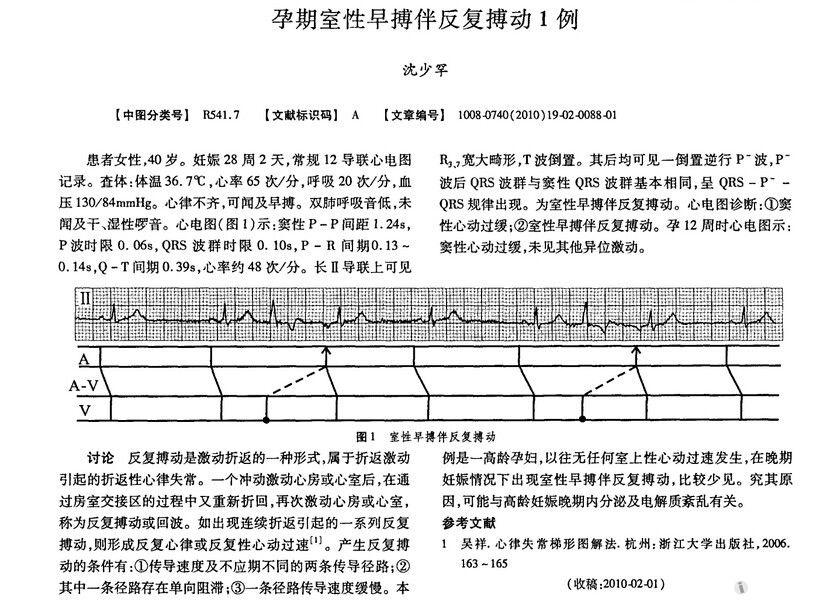 室早伴反复搏动 - 心电图脑电图专业讨论版 - 爱爱医