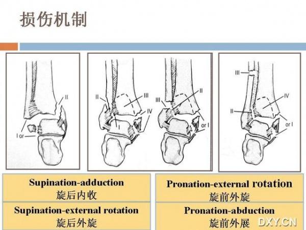 转个 下胫腓关节分离的诊治.