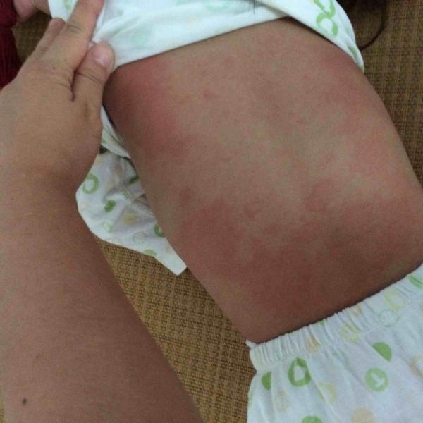 大家帮我看看宝宝是不是感染性荨麻疹