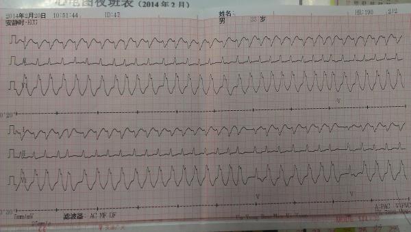 预激综合征合并房颤?室速? - 心电图脑电图专业讨论版