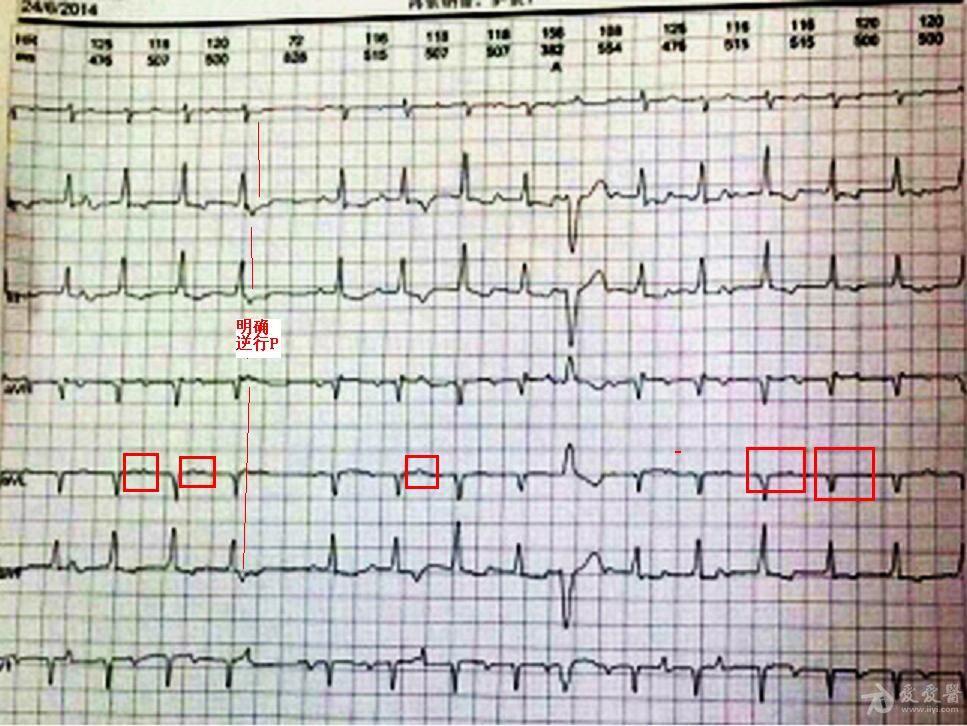 有一个明确的逆行p,其它红色方框内的p波似乎与前一个qrs关系不固定