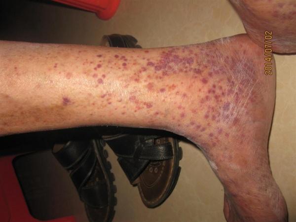 小腿红斑,不痛不痒2月,这是什么皮肤病-------过敏性紫癜
