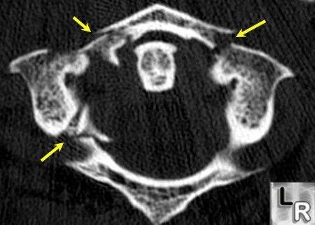 52jefferson 骨折efferson骨折指颈部轴向负荷导致的寰椎c1爆裂骨折