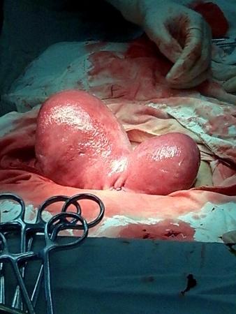双子宫双阴道妊娠剖宫分娩