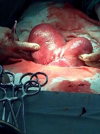 产后复查发现胎盘植入_女子怀孕8月相亲 贴吧_女子产后3个月发现又怀孕2个月