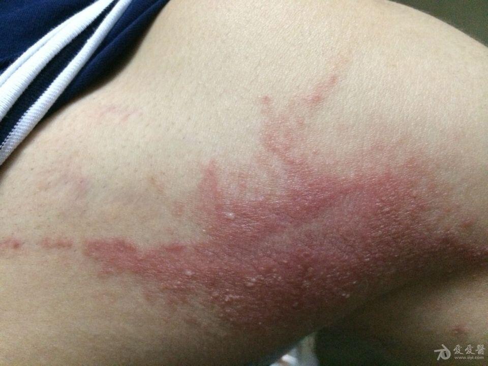 隐翅虫皮炎