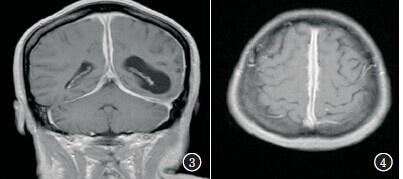 【学习】肥厚性硬脑膜炎1例
