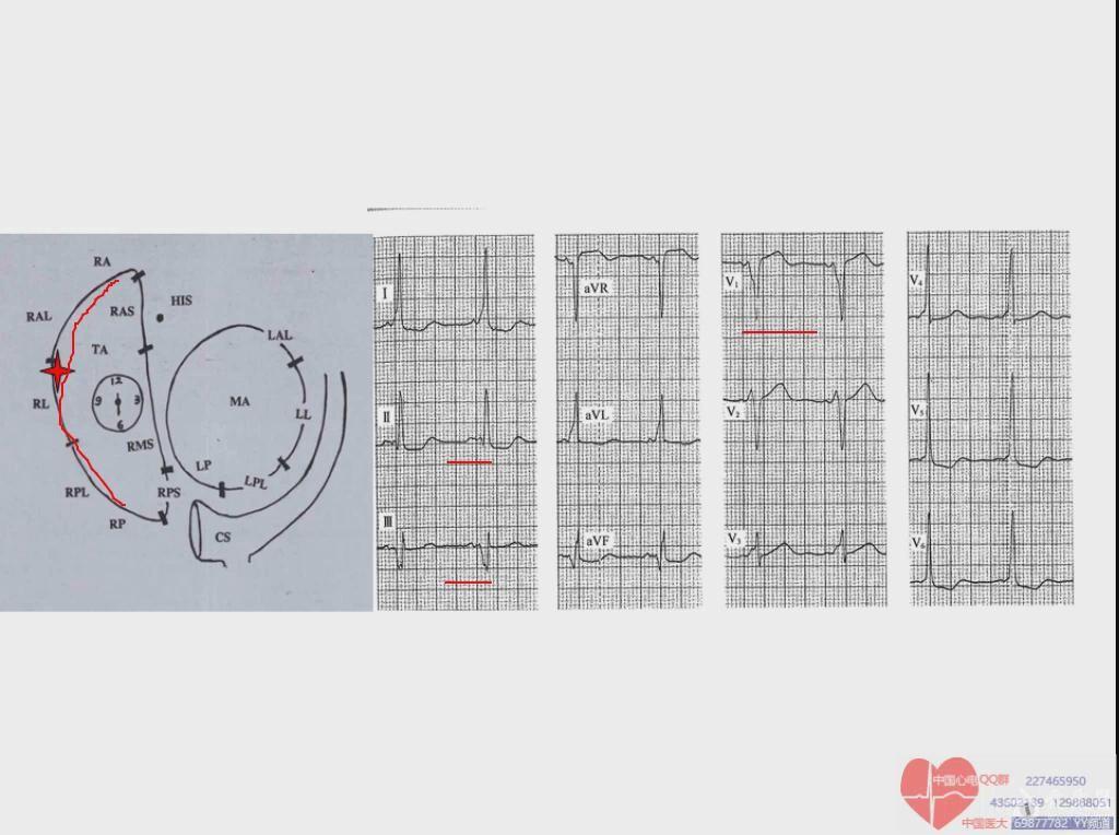 预激旁路心电图定位确认一下!