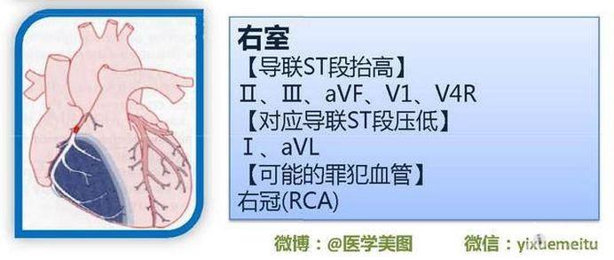 一图读懂:心梗心电图改变