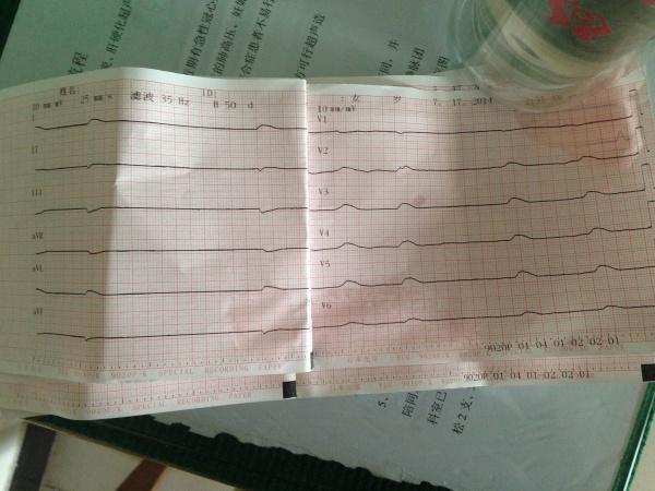 帮忙看看这四张心电图临死前的 每一张报什么啊?