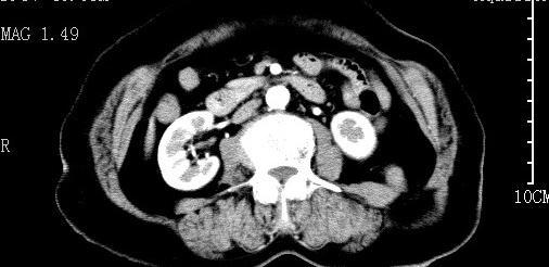ct:左腰部后腹壁不连续,可见囊袋样影突出于腹壁外,内见