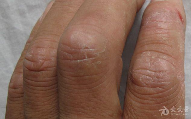 手指节干裂 - 皮肤及性传播疾病讨论版 - 爱爱医医学