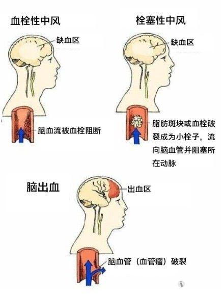 缺血性脑卒中与出血性脑卒中