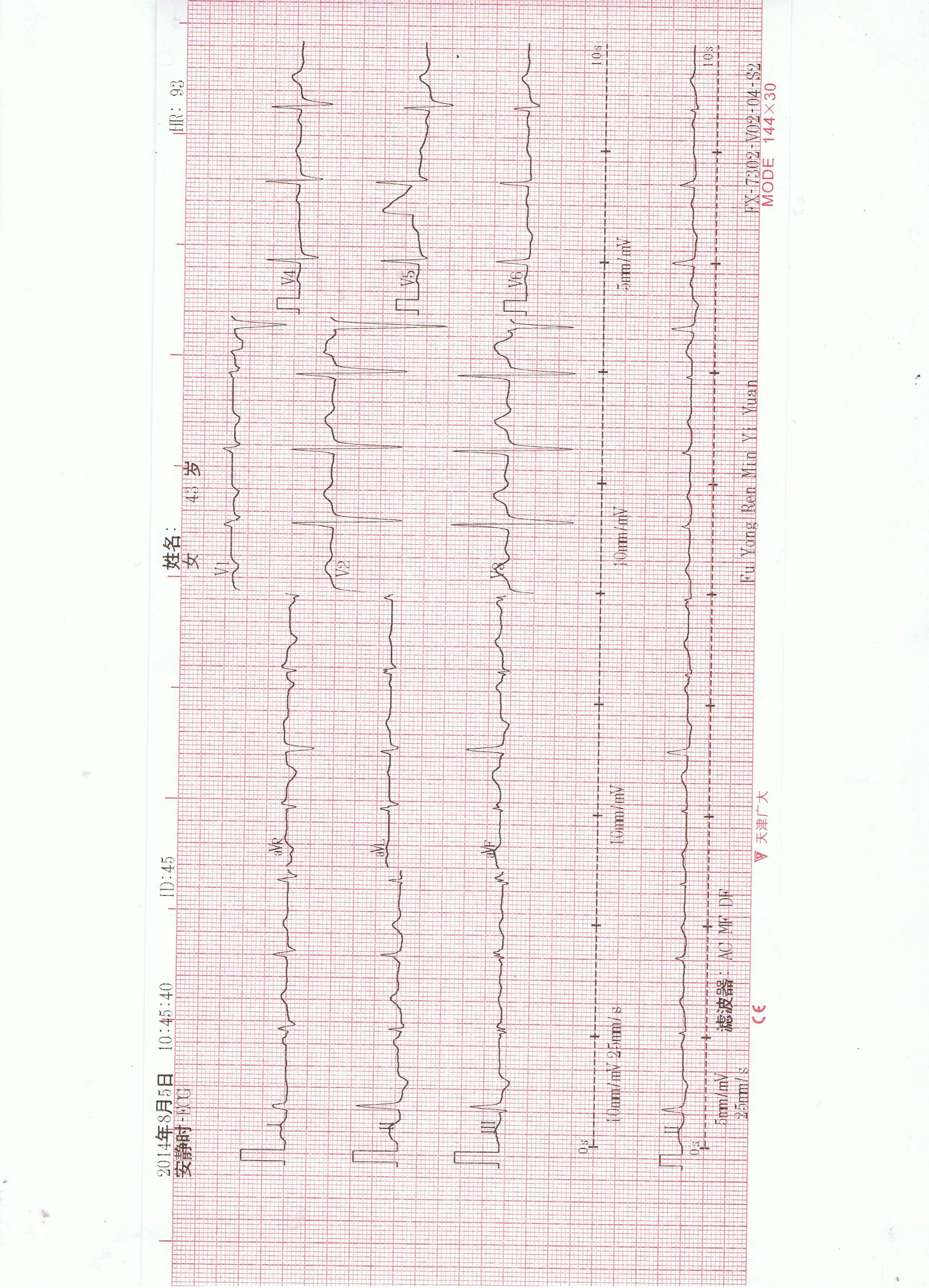 请各位老师帮忙分析一下这份心电图.急.