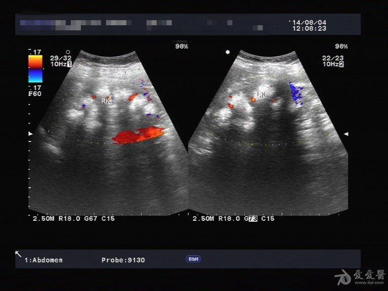 双侧海绵肾 - 超声医学讨论版 - 爱爱医医学论坛 - 医