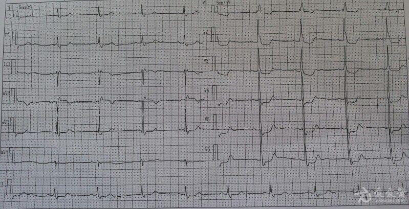 典型心电图!