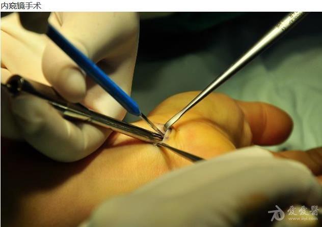 手麻的常见病因——腕管综合症,针刀如何相对彻底治疗